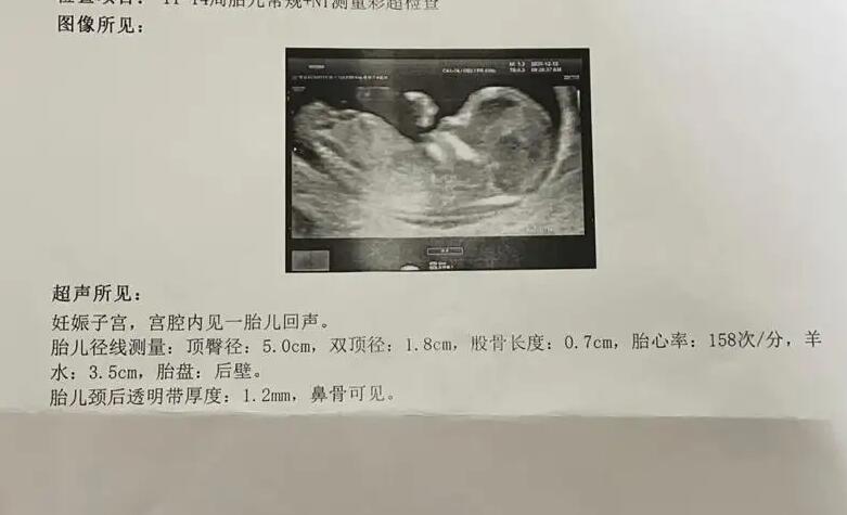 三代试管广东 广东省生育登记政策补充 ‘怎么看孕囊知道男孩女孩’