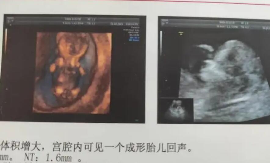 深圳试管的医院 2023深圳市妇幼保健院做试管供卵生男孩费用清单全面讲解 ‘彩超孕囊形状看男女准确吗?’