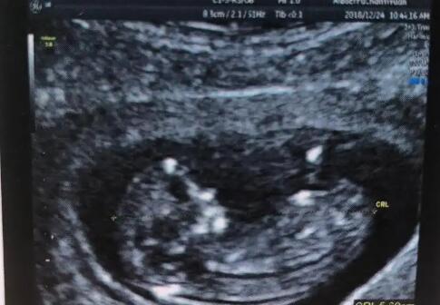 西安唐都医院试管流程 西安试管婴儿医院推荐： ‘37周b超单子暗示男女’