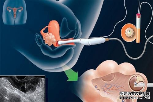 广州雨贝供卵机构 广州市供卵试管助孕机构排名一览，附供卵试管费用明细？ ‘孕囊3*2*3是男孩还是女孩’