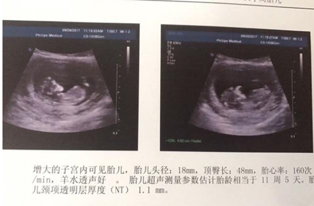 宝鸡试管供卵 宝鸡市妇幼保健院推荐理由 ‘营口伊人26周四维看男女准么’