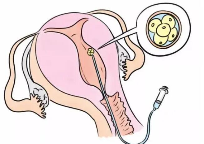 美国试管婴儿资讯：影响囊胚着床的四大因素