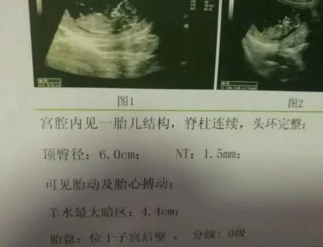 嘉兴供卵试管 嘉兴市妇幼保健院开展的辅助生殖技术一览: ‘3个半月双顶径3.2是男孩还是女孩’