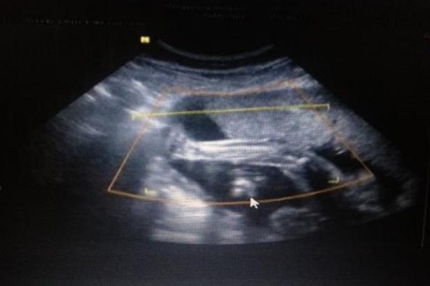 试管婴儿为什么在肚子上打针？怎么给自己打针？