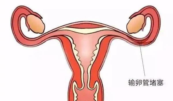 广州中山附属一院做试管流程 广州地下试管婴儿 ‘男孕囊和女孕囊的区别’