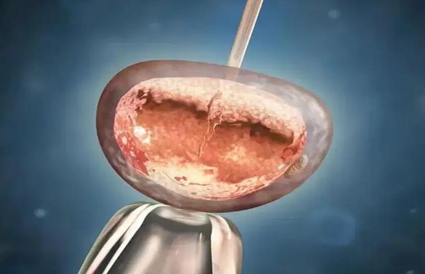 泰国试管婴儿真实经历试管婴儿要注重哪些环节？