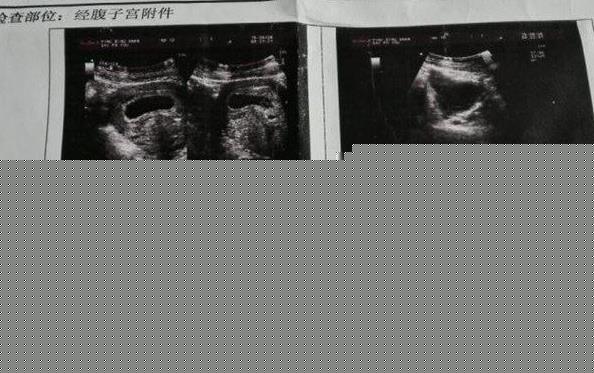 杭州做供卵试管过程 杭州邵逸夫可以供卵试管婴儿吗? ‘双顶径和股骨长1.9是男女’