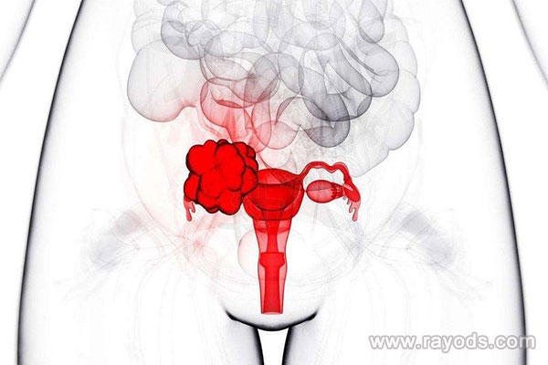 巧克力囊肿的危害