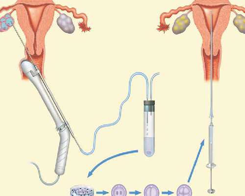 成都试管婴儿技术靠谱吗？成功率高不高